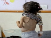 أونروا لـ "الكوفية": 17 ألف طفل في غزة وصلوا لمستويات قياسية من سوء التغذية
